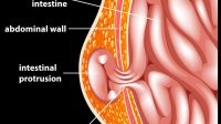 how-to-prevent-hernia-from-getting-worse_936353752.jpg